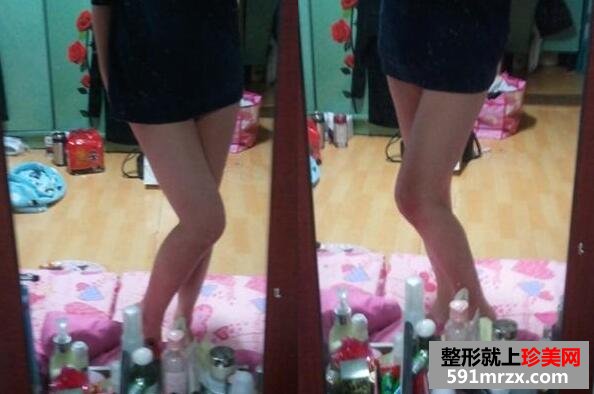 大腿吸脂整形手术真实案例前后对比照