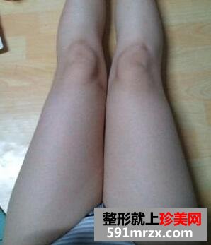 大腿吸脂整形手术真实案例前后对比照