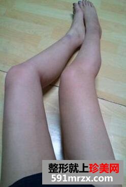 大腿吸脂整形手术真实案例前后对比照