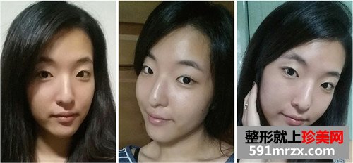 注射式隆鼻整形+韩式微创双眼皮术前后效果对比图和恢复过程