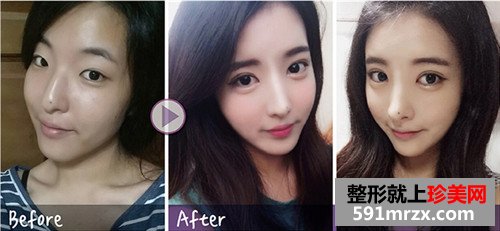 注射式隆鼻整形+韩式微创双眼皮术前后效果对比图和恢复过程