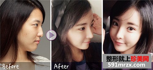 注射式隆鼻整形+韩式微创双眼皮术前后效果对比图和恢复过程