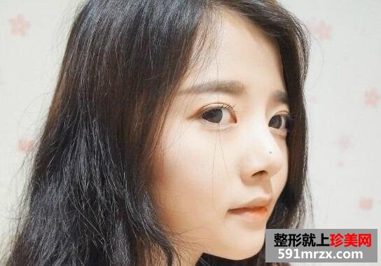 硅胶隆鼻整形手术前后对比案例照片