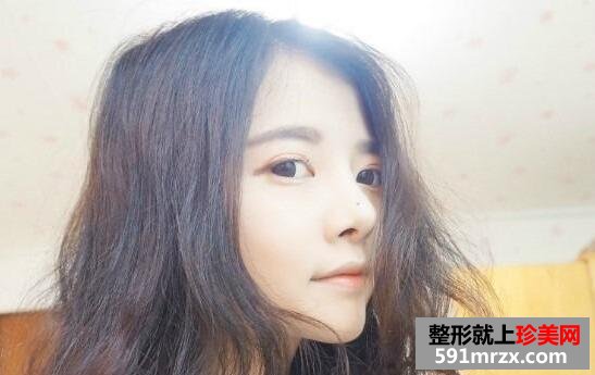 硅胶隆鼻整形手术前后对比案例照片