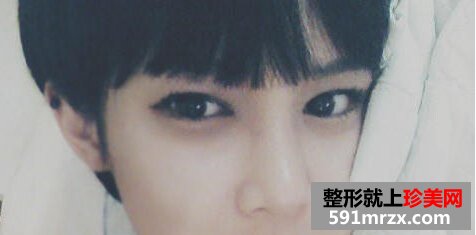 假体隆鼻后多久会自然 隆鼻五个月后的样子