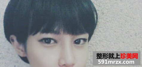 假体隆鼻后多久会自然 隆鼻五个月后的样子