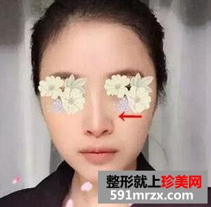假体隆鼻恢复图经历分享