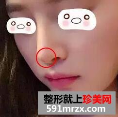 从歪鼻到翘鼻，我只用了一个射极峰3D