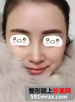 假体隆鼻恢复图经历分享