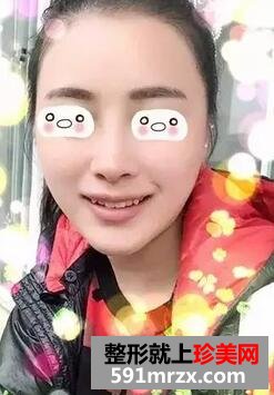 从歪鼻到翘鼻，我只用了一个射极峰3D