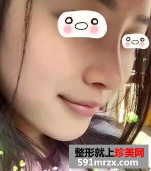 从歪鼻到翘鼻，我只用了一个射极峰3D