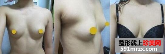 水滴型硅胶假体隆胸手术前后效果对比真人案例分享