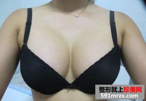 水滴型硅胶假体隆胸手术前后效果对比真人案例分享