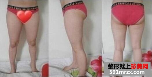 大腿吸脂减肥真实恢复过程对比图