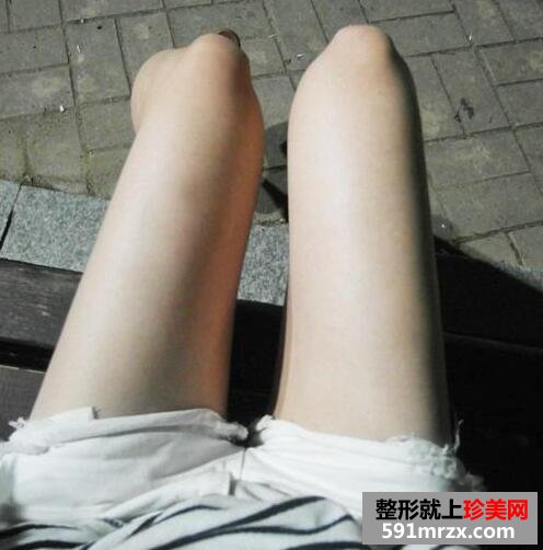 大腿吸脂减肥真实恢复过程对比图