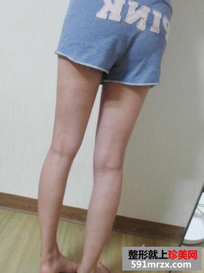 大腿吸脂减肥真实恢复过程对比图