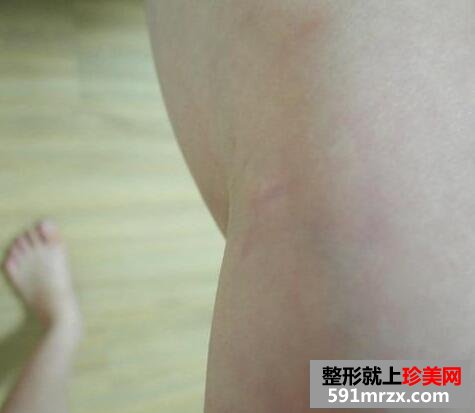 大腿吸脂减肥真实恢复过程对比图