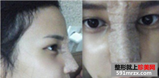 假体隆鼻后多久会自然 隆鼻五个月后的样子