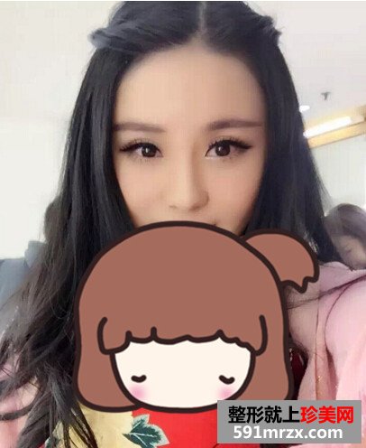 北京米扬丽格巫文云隆鼻案例图片？