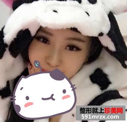 北京米扬丽格巫文云隆鼻案例图片？