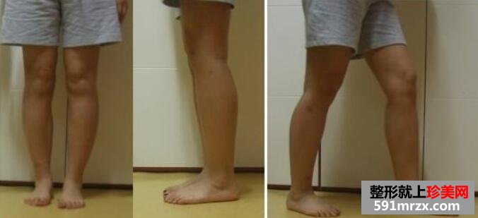 小腿吸脂小腿肌肉切除手术前后对比图
