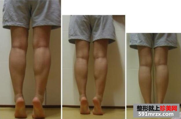 小腿吸脂小腿肌肉切除手术前后对比图