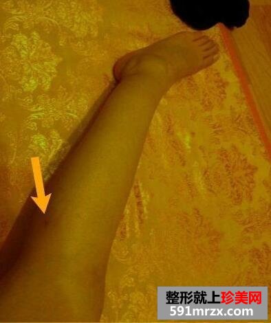 小腿吸脂小腿肌肉切除手术前后对比图