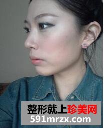 去黑眼圈脸部自体脂肪移植手术真实案例对比图