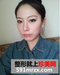 去黑眼圈脸部自体脂肪移植手术真实案例对比图