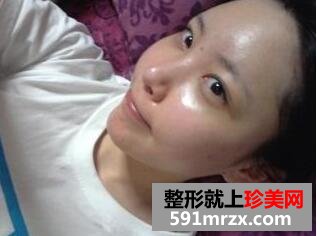 去黑眼圈脸部自体脂肪移植手术真实案例对比图
