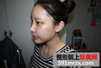 去黑眼圈脸部自体脂肪移植手术真实案例对比图