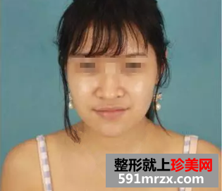玻尿酸隆鼻恢复效果分享