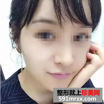 玻尿酸隆鼻恢复效果分享