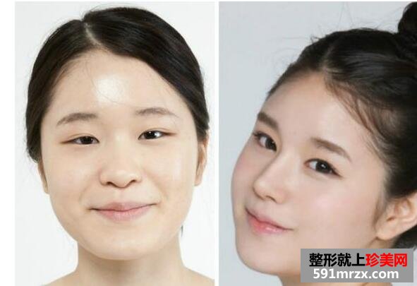 双眼皮开内眼角硅胶隆鼻手术真人案例面诊全过程