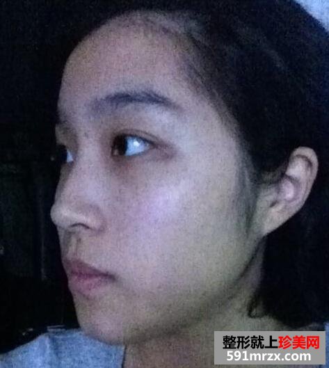 下巴整形手术全过程前后对比图最新分享