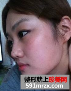 V-LINE瓜子脸面部手术案例对比图