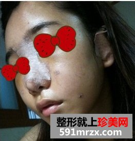 上海万众整形医院假体综合隆鼻前后对比效果图片