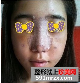 上海万众整形医院假体综合隆鼻前后对比效果图片