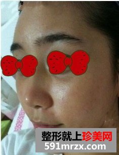 上海万众整形医院假体综合隆鼻前后对比效果图片