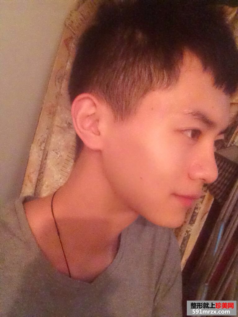 上海华美李志海博士下颌角磨骨案例，价格表