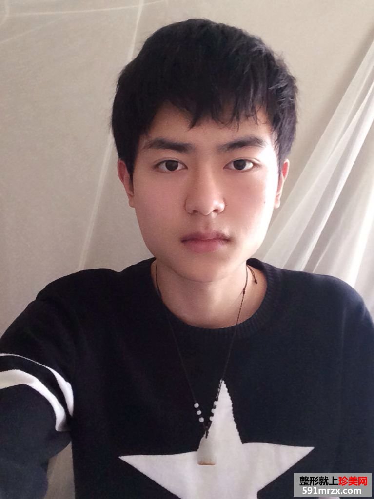 上海华美李志海博士下颌角磨骨案例，价格表