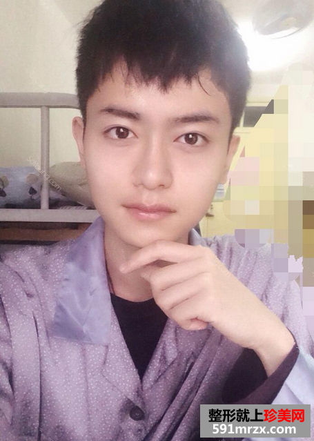 上海华美李志海博士下颌角磨骨案例，价格表