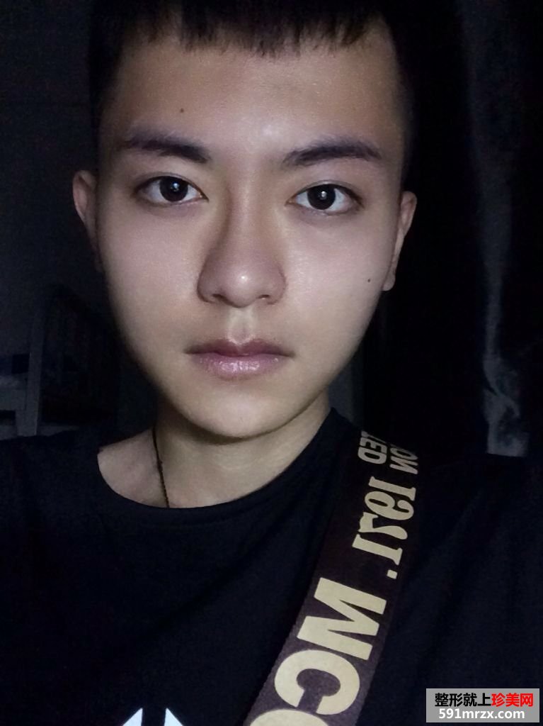 上海华美李志海博士下颌角磨骨案例，价格表