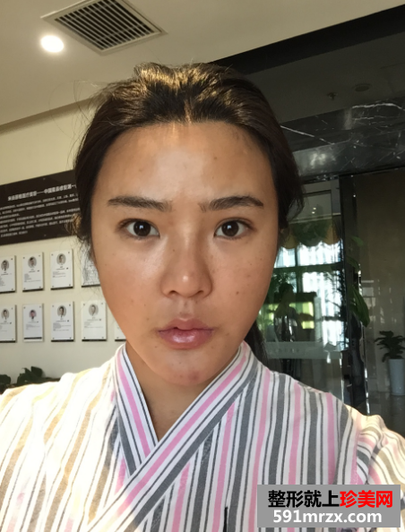 北京米杨丽格巫文云隆鼻修复案例，价格