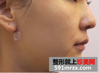 什么是4d提拉回春术？让我魔幻般回到了青春
