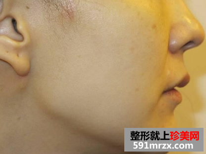 什么是4d提拉回春术？让我魔幻般回到了青春