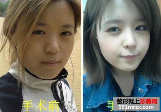 硅胶隆鼻移植软骨整形手术前后真实对比图