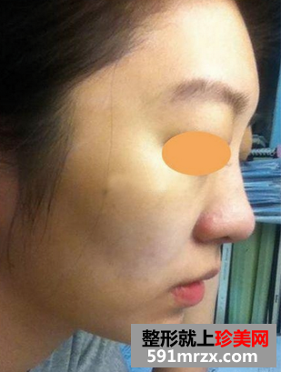 韩式隆鼻前后对比照 韩式隆鼻真人案例分享