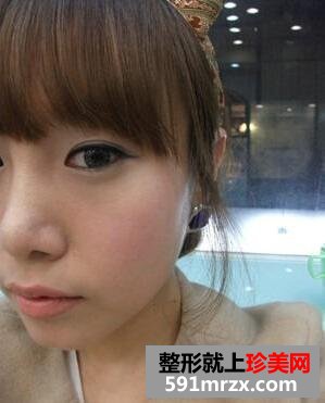 埋线法双眼皮+硅胶隆鼻整形手术前后对比照