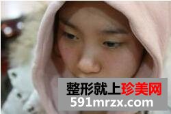 埋线法双眼皮+硅胶隆鼻整形手术前后对比照